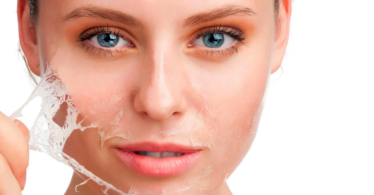 Chemical Peels at Skin Forma, Luton