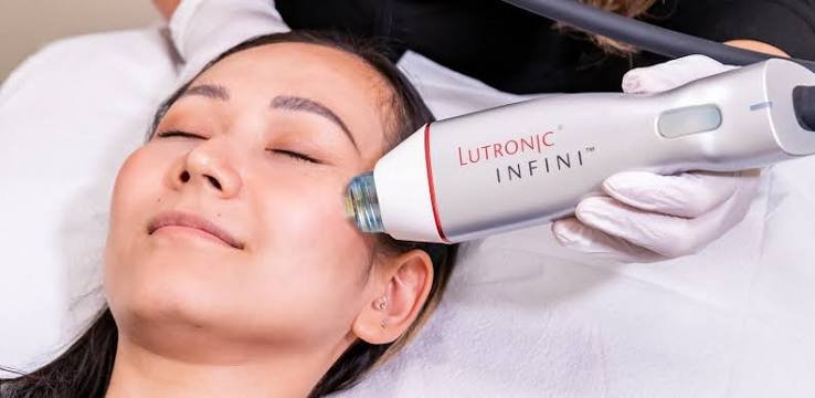HF Microneedling at Skin Forma, Luton