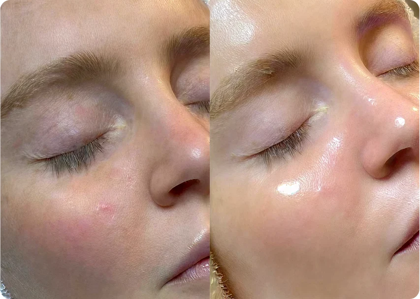 HydraFacial at Skin Forma, Luton